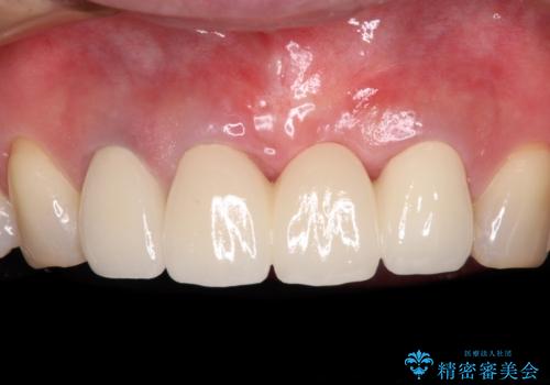 抜かなければいけない前歯 歯肉移植を用いたオールセラミックブリッジの症例 治療後
