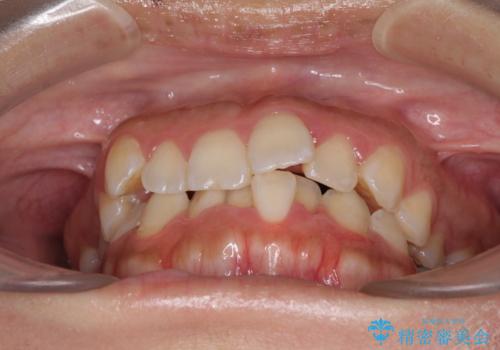 前歯のデコボコをインビザラインでスッキリとの治療前