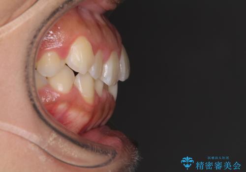 前歯のデコボコをインビザラインでスッキリとの治療前