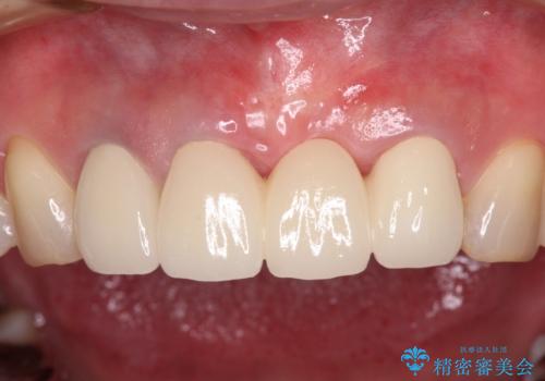 抜かなければいけない前歯 歯肉移植を用いたオールセラミックブリッジの治療後