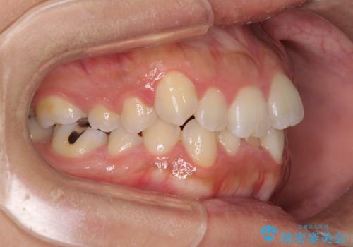 前歯のデコボコをインビザラインでスッキリとの治療前