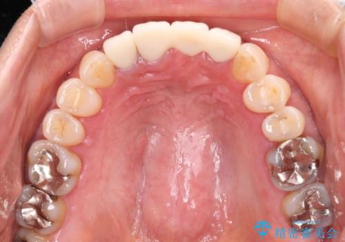 抜かなければいけない前歯 歯肉移植を用いたオールセラミックブリッジの治療後