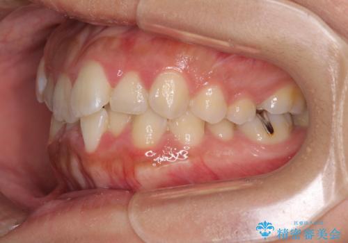 前歯のデコボコをインビザラインでスッキリとの治療前