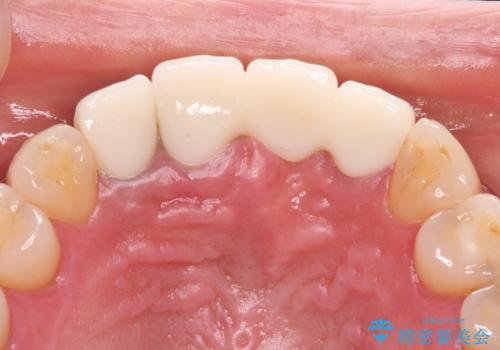 抜かなければいけない前歯 歯肉移植を用いたオールセラミックブリッジの治療後