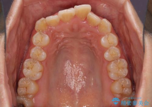 前歯のデコボコをインビザラインでスッキリとの治療前