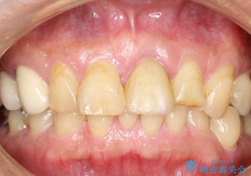 折れた前歯を使えるように、抜かないで残す方法の症例 治療後