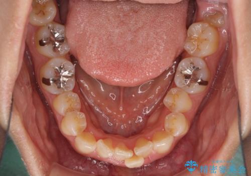 前歯のデコボコをインビザラインでスッキリとの治療前