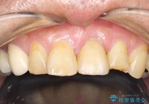 折れた前歯を使えるように、抜かないで残す方法の治療後