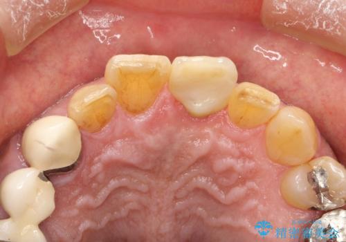 折れた前歯を使えるように、抜かないで残す方法の治療後