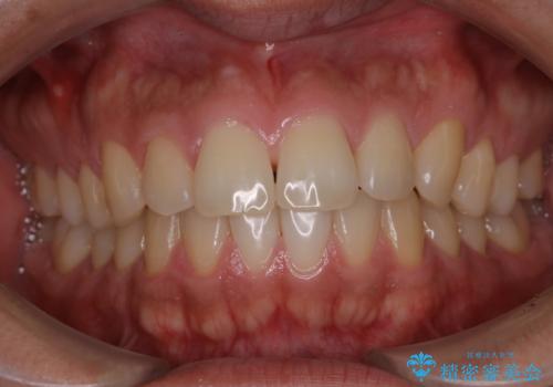 電子タバコによる着色をPMTCできれいに落とすの治療前