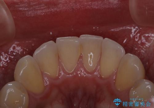 電子タバコによる着色をPMTCできれいに落とすの治療前