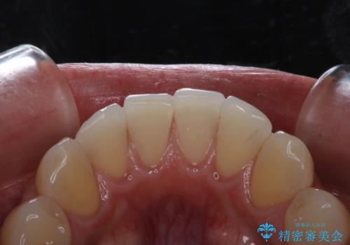 電子タバコによる着色をPMTCできれいに落とすの治療後