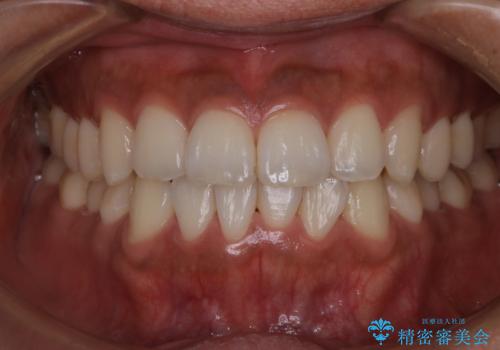 PMTCで口元を爽快感にスッキリとの治療前