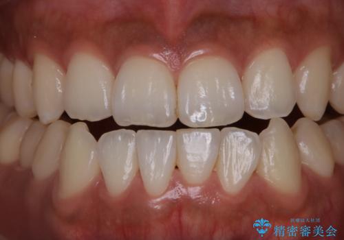 PMTCで口元を爽快感にスッキリとの治療前