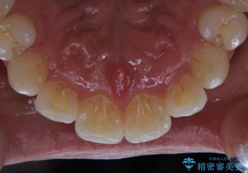 PMTCで口元を爽快感にスッキリとの治療前