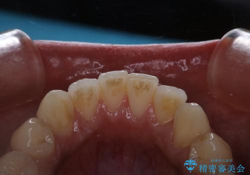 PMTCで口元を爽快感にスッキリとの症例 治療前