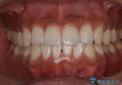 PMTCで口元を爽快感にスッキリとの治療後