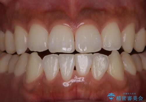 PMTCで口元を爽快感にスッキリとの治療後