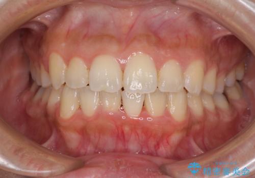 前歯のデコボコをインビザラインでスッキリとの治療中