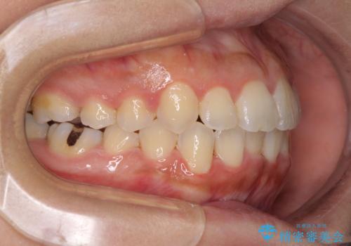 前歯のデコボコをインビザラインでスッキリとの治療中