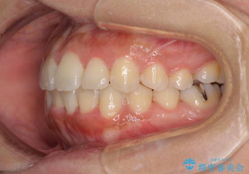 前歯のデコボコをインビザラインでスッキリとの治療中