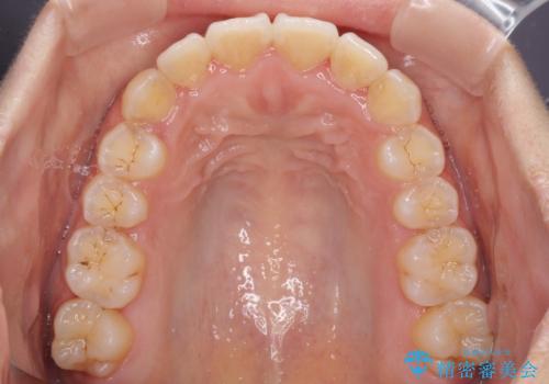 前歯のデコボコをインビザラインでスッキリとの治療中