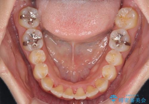 前歯のデコボコをインビザラインでスッキリとの治療中