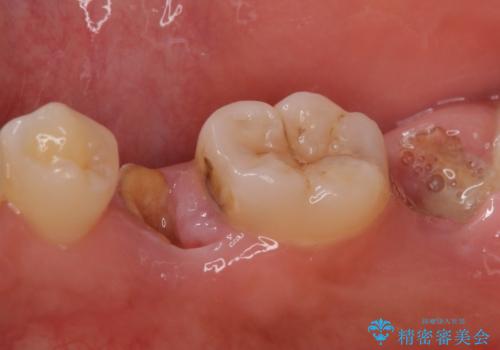 歯が折れた 低予算でオールセラミックのブリッジ 20代女性の治療前