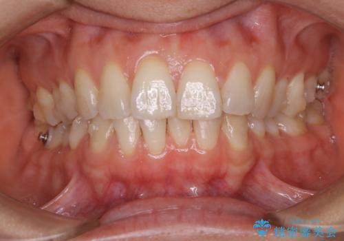 上下の真ん中を合わせて横顔シルエットも改善の治療中