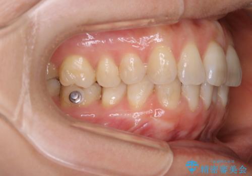 上下の真ん中を合わせて横顔シルエットも改善の治療中