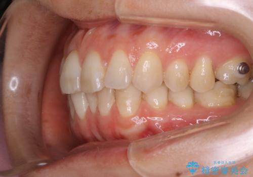 上下の真ん中を合わせて横顔シルエットも改善の治療中