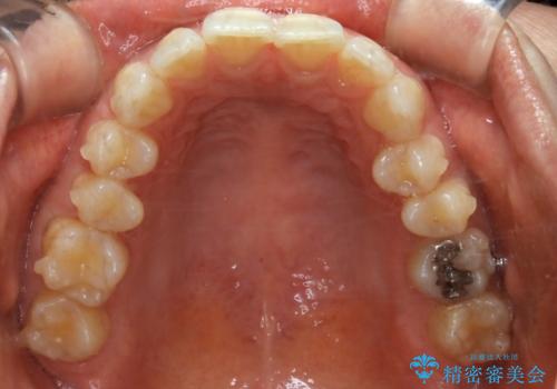 上下の真ん中を合わせて横顔シルエットも改善の治療中