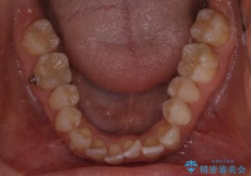 上下の真ん中を合わせて横顔シルエットも改善の治療中