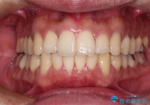 下顎骨が顕著に右側にずれている　インビザラインによる咬合改善の症例 治療後