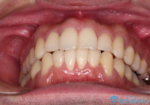 下顎骨が顕著に右側にずれている インビザラインによる咬合改善の治療後