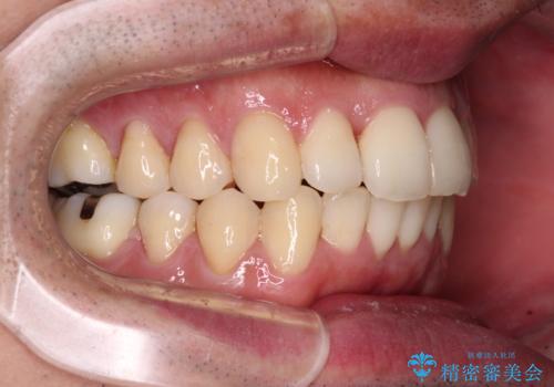 下顎骨が顕著に右側にずれている インビザラインによる咬合改善の治療後