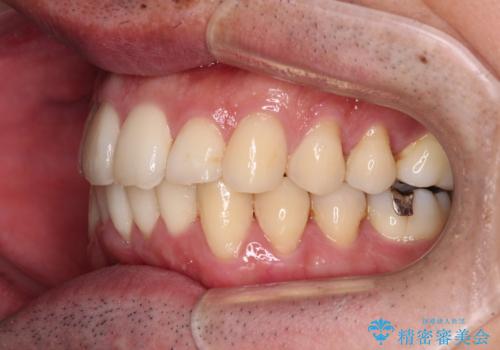 下顎骨が顕著に右側にずれている インビザラインによる咬合改善の治療後