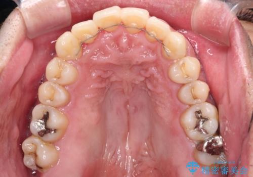 下顎骨が顕著に右側にずれている インビザラインによる咬合改善の治療後