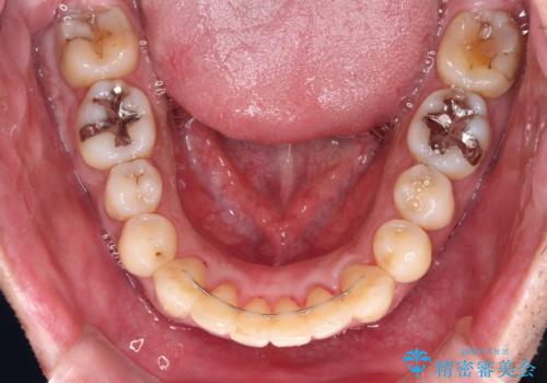 下顎骨が顕著に右側にずれている インビザラインによる咬合改善の治療後