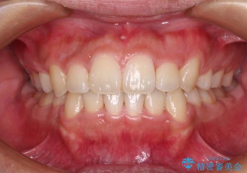 気になる八重歯を治したい 目立たないワイヤーでの抜歯矯正の治療後