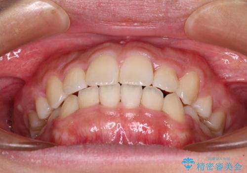 気になる八重歯を治したい 目立たないワイヤーでの抜歯矯正の治療後