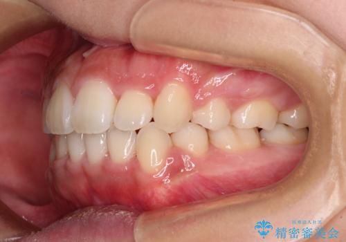気になる八重歯を治したい 目立たないワイヤーでの抜歯矯正の治療後