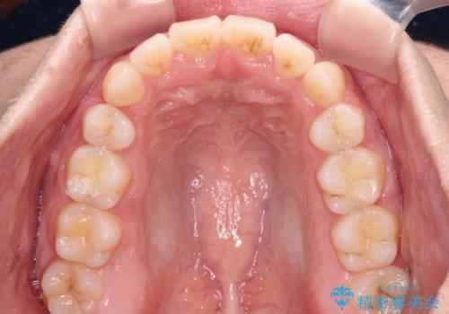 気になる八重歯を治したい 目立たないワイヤーでの抜歯矯正の治療後