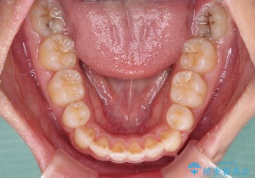 気になる八重歯を治したい 目立たないワイヤーでの抜歯矯正の治療後