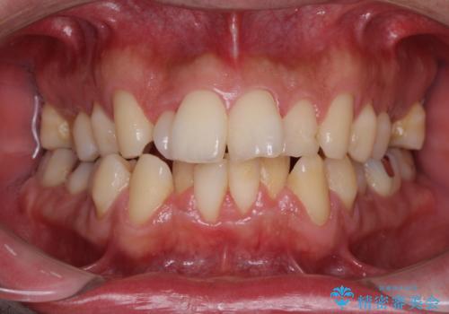 下顎骨が顕著に右側にずれている インビザラインによる咬合改善の治療前