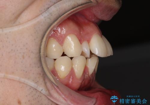 下顎骨が顕著に右側にずれている インビザラインによる咬合改善の治療前