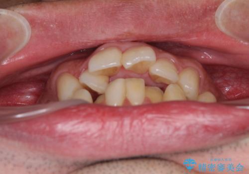 下顎骨が顕著に右側にずれている インビザラインによる咬合改善の治療前