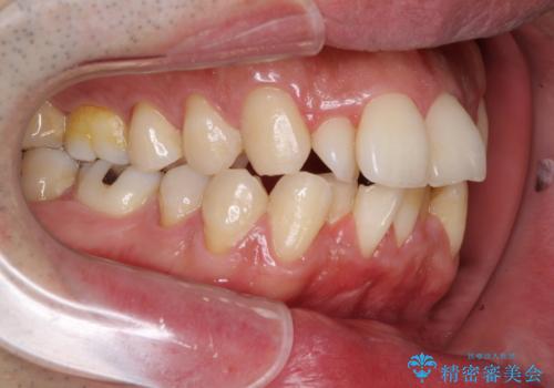 下顎骨が顕著に右側にずれている インビザラインによる咬合改善の治療前