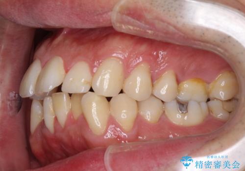 下顎骨が顕著に右側にずれている インビザラインによる咬合改善の治療前