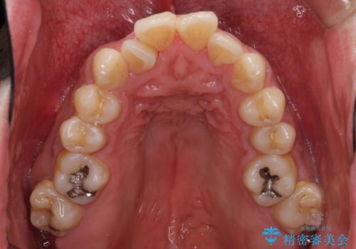 下顎骨が顕著に右側にずれている インビザラインによる咬合改善の治療前